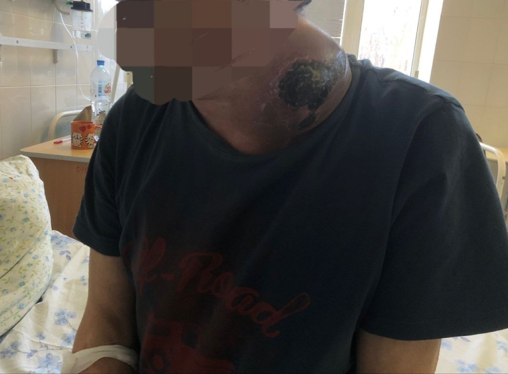 Омские врачи удалили мужчине шишку размером с дыню-колхозницу на шее